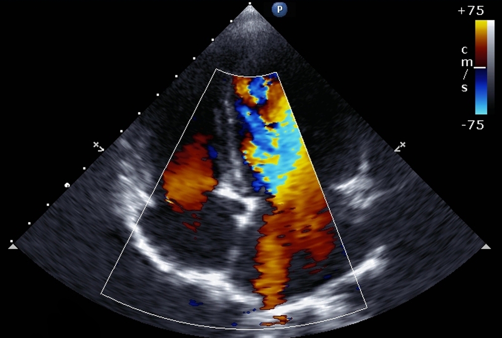 Transthoracic two-dimensional color Doppler echocardiography. Credit: Shutterstock.