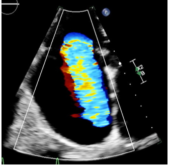 echocardiogram