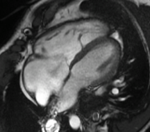 cardiac MRI