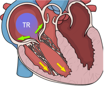Tricuspid regurgitation (TR)